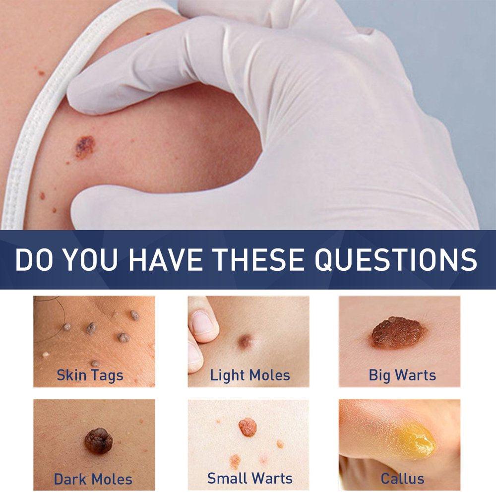 Wart and Hpv,Moles Common and Genital Wart Remover Painless and Fast-Acting